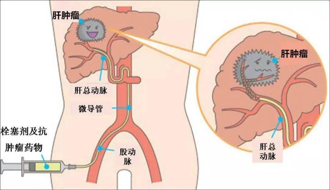 【聚焦临床】巨块型肝癌介入治疗再添"硬核武器"——载药微球!