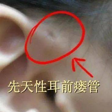 【诊治参考】耳后瘘管的诊断与治疗_皮肤