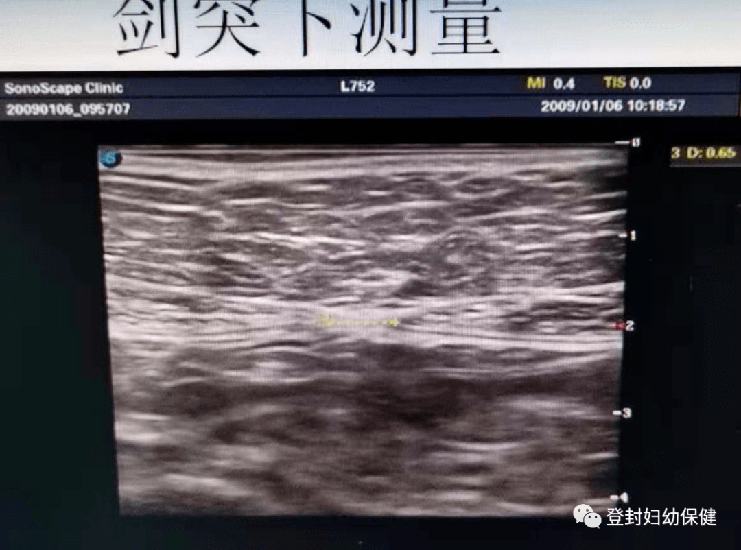 【妇幼技术】宝妈妈,你的腹直肌经过超声检测了吗?