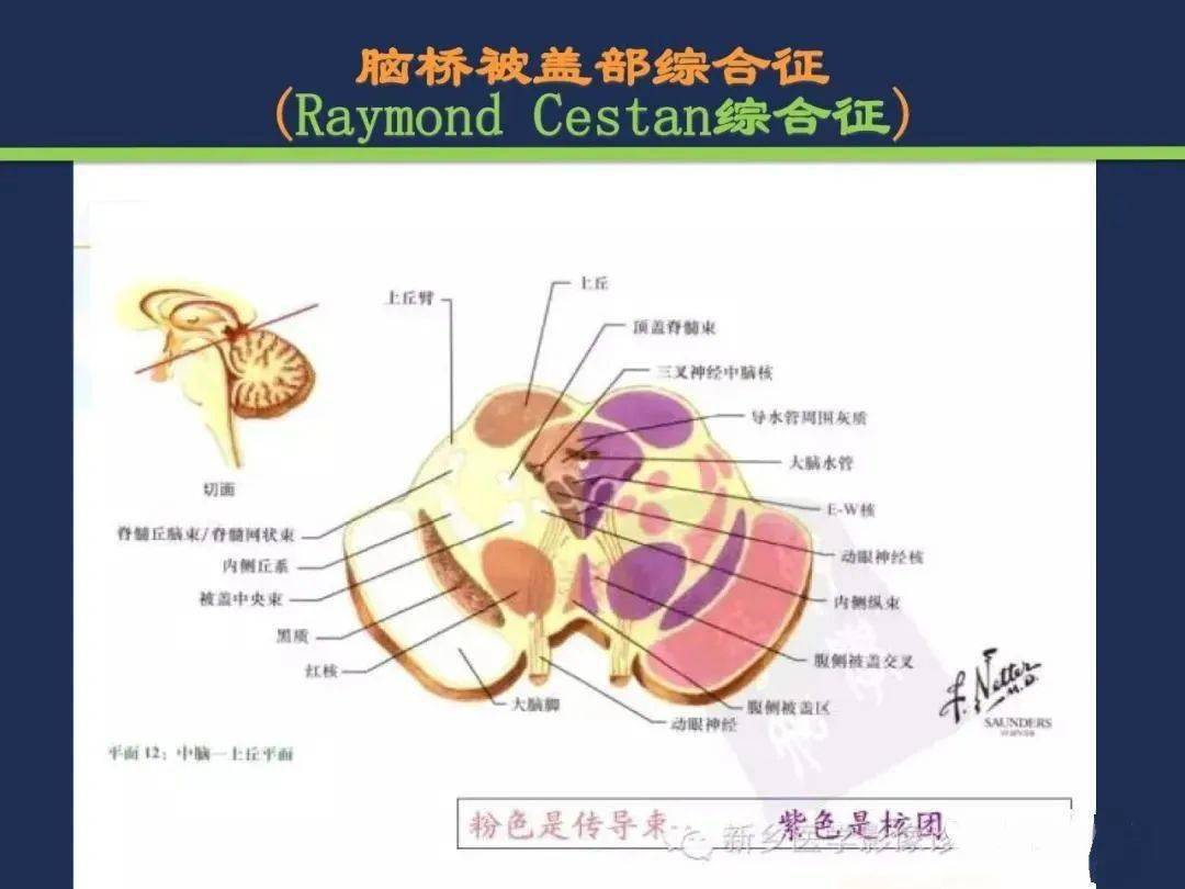 从梗死部位推测责任血管脑血管解剖