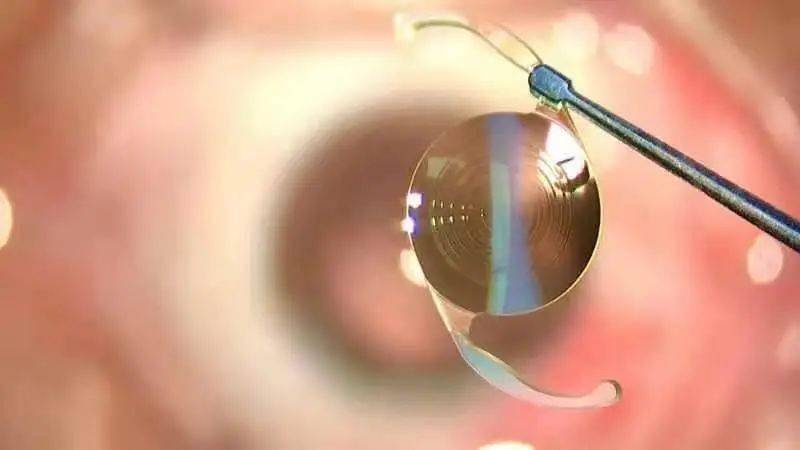 十堰首例爱尔康三焦点人工晶体植入术在十堰爱尔眼科成功开展