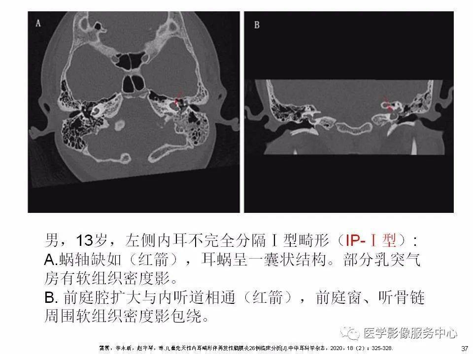 本文目录 第一部分:耳蜗解剖 第二部分:内耳畸形分类,主要基于ct 第