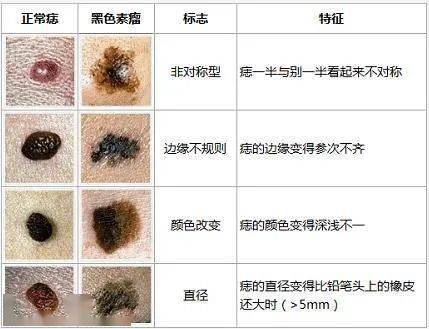 黑色素瘤多学科诊疗开诊啦