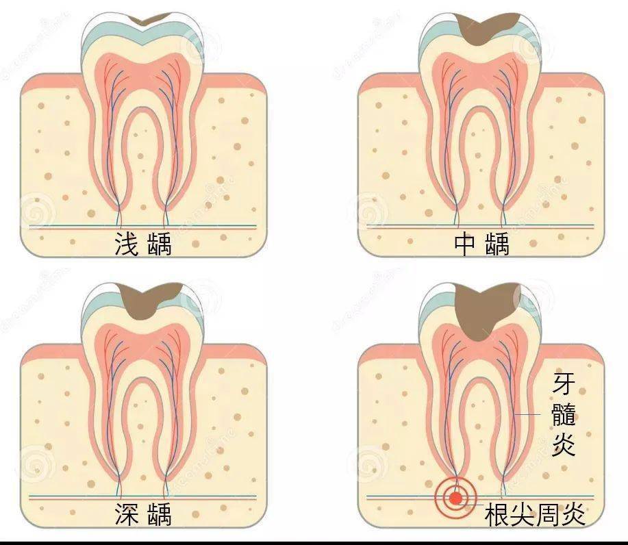 根管治疗,留住你牙齿的最后机会