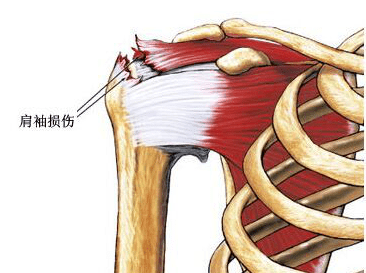 当这些肌腱软组织受损时,即为肩袖损伤.
