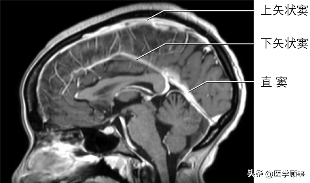 所以从cta/ctv,mra/mrv或增强t1上,通过下矢状窦可以判断大脑镰下缘
