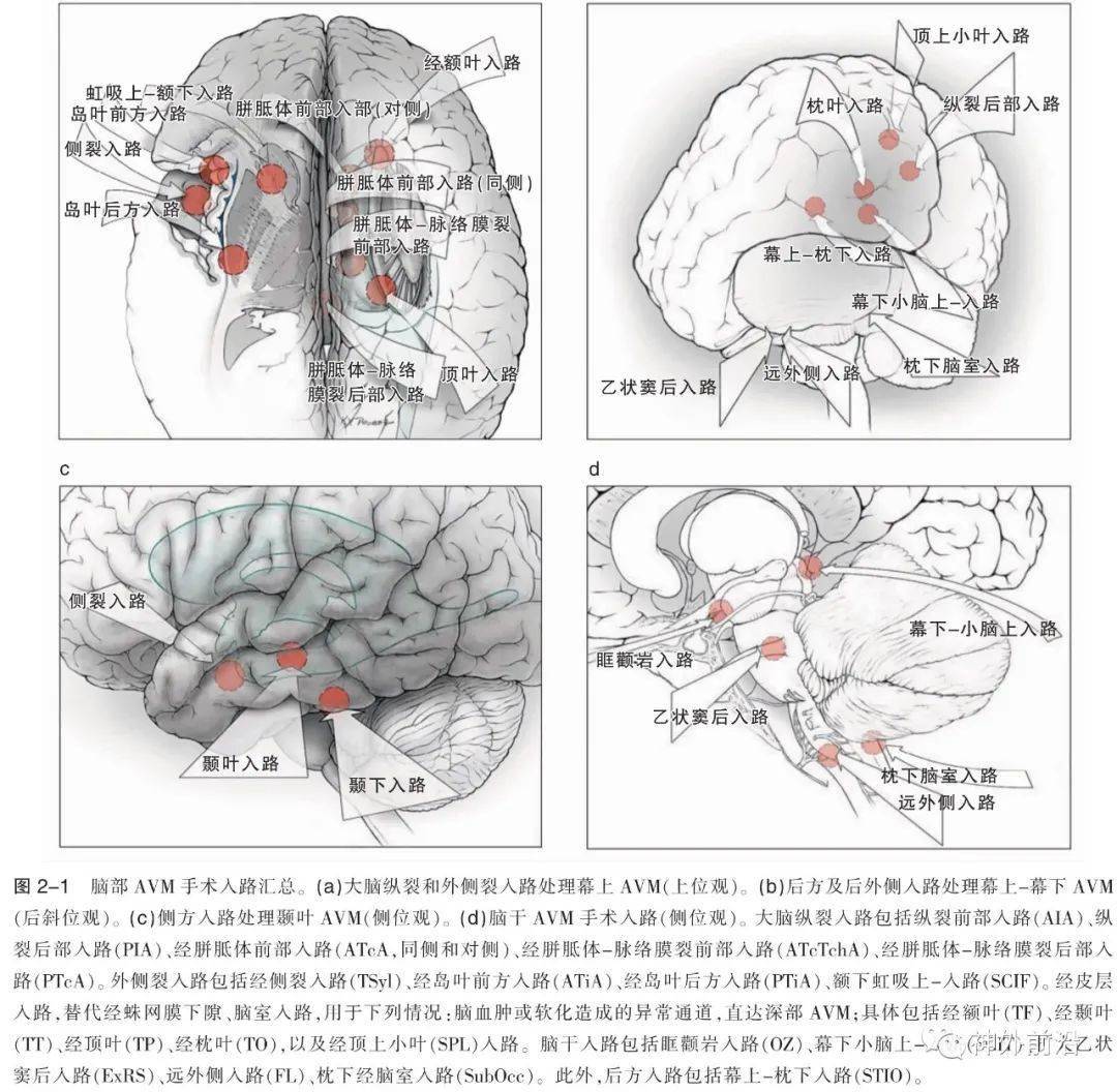 神经解剖 | 分离蛛网膜下隙 —七种类型动静脉畸形-手术策略及技巧