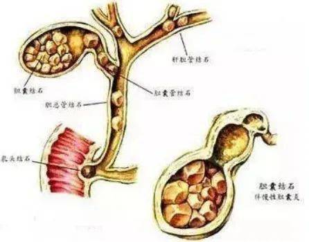 小知识得了胆囊结石手术到底做不做