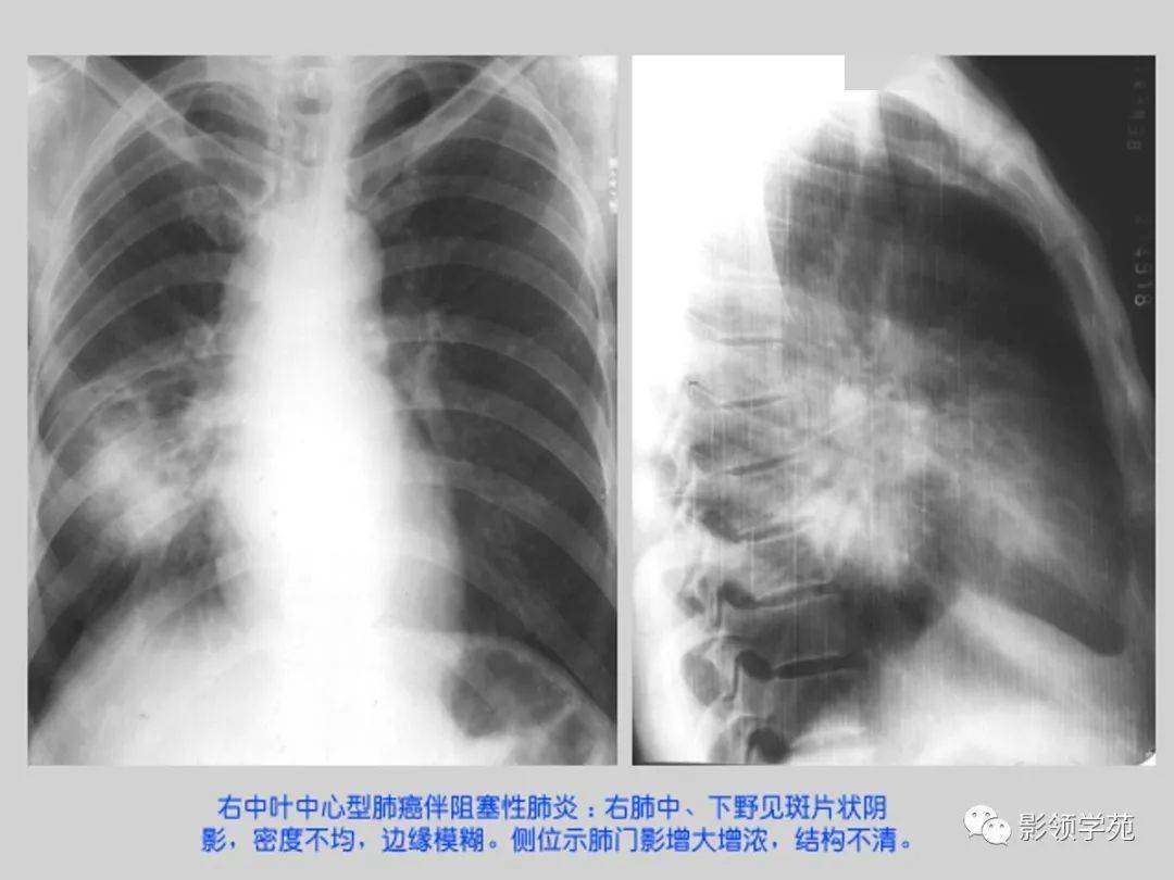 肺部常见疾病的影像诊断