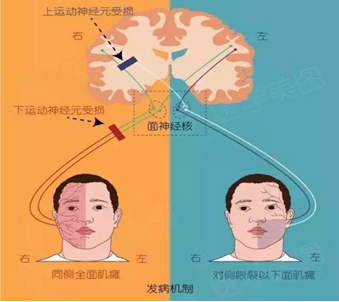 左图为周围性面瘫,右图为中枢性面瘫