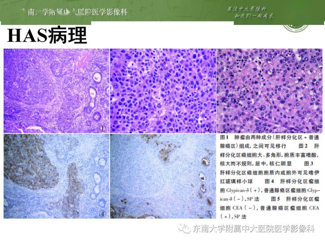 重点学习:胃肝样腺癌影像诊断