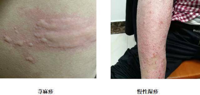 对于易罹患湿疹,荨麻疹,银屑病等与变态反应有关皮肤病的朋友,要注意