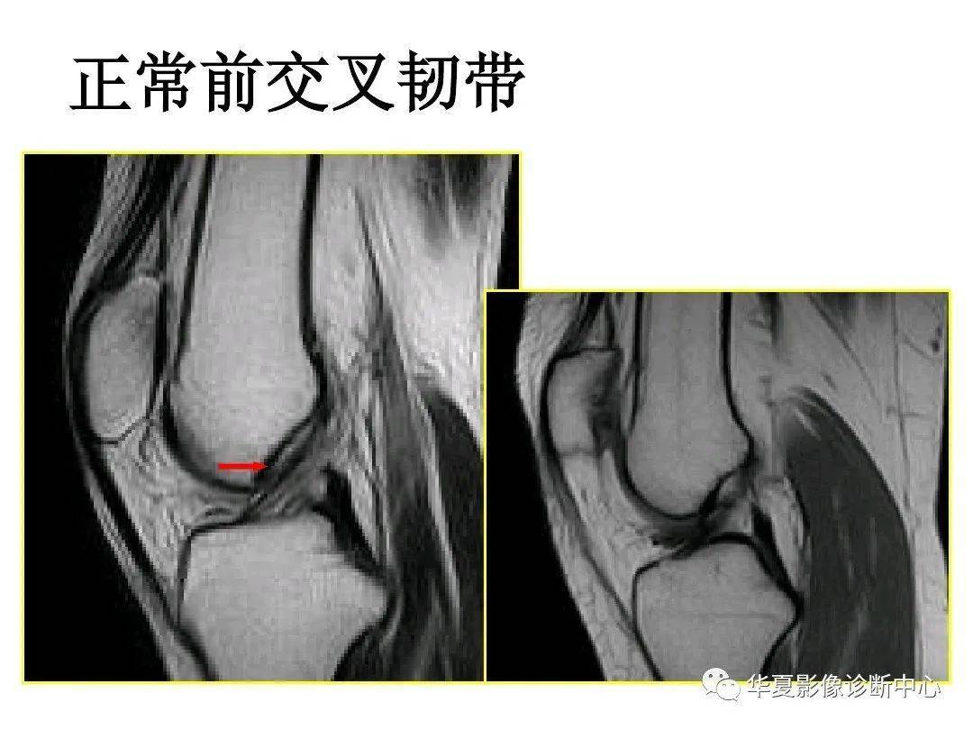 交叉韧带解剖及损伤的mri诊断