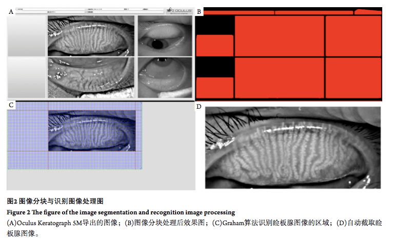 基于红外成像原理的睑板腺图像量化分析系统眼科学报杂志文章精选