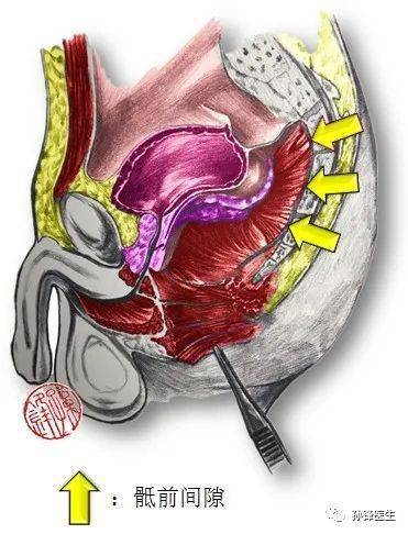 医学图说|一例骶前畸胎瘤的核磁影像(原创图文)