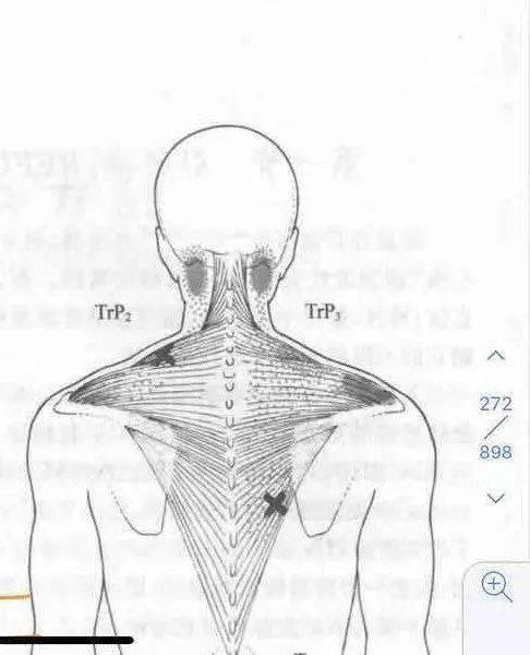 点角度分析,大家已经可以发现上斜方肌存在触发点对肩关节的重大影响
