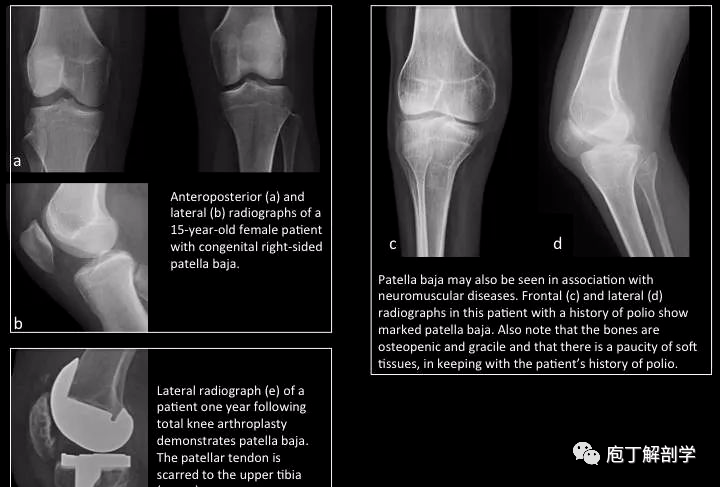 图解髌骨正常解剖,变异及常见疾病