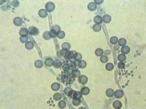 3滴虫性阴道炎病因:这是因为感染阴道毛滴虫导致的,因为滴虫会吞噬