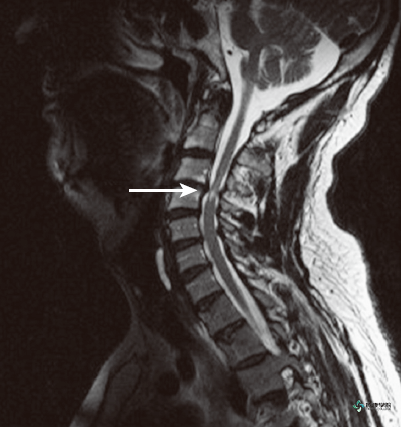疼痛解剖学|颈椎间盘疾病的命名