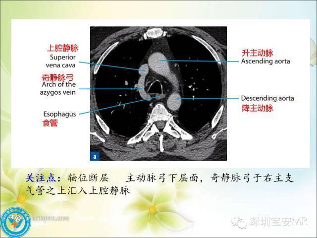 推荐丨肺动脉和肺静脉影像断层解剖