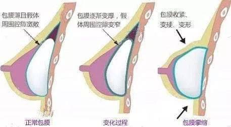 自体脂肪和假体隆胸该怎么选?