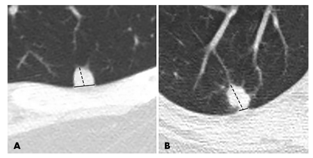 肺癌ct筛查中胸膜下结节的处理
