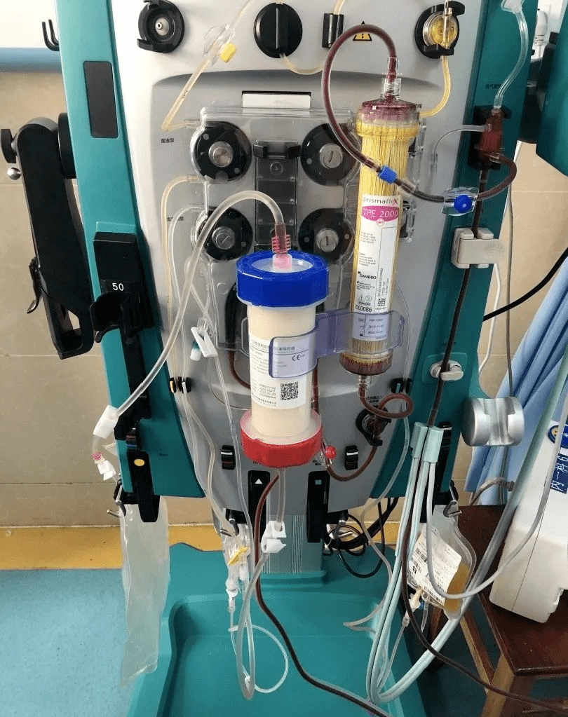 型人工肝的新的组合方式,采用血浆分离器和离子交换树脂进行联合治疗
