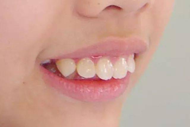 深覆颌上牙包住下牙的范围过大,情况严重者甚至可以咬到下牙牙龈.