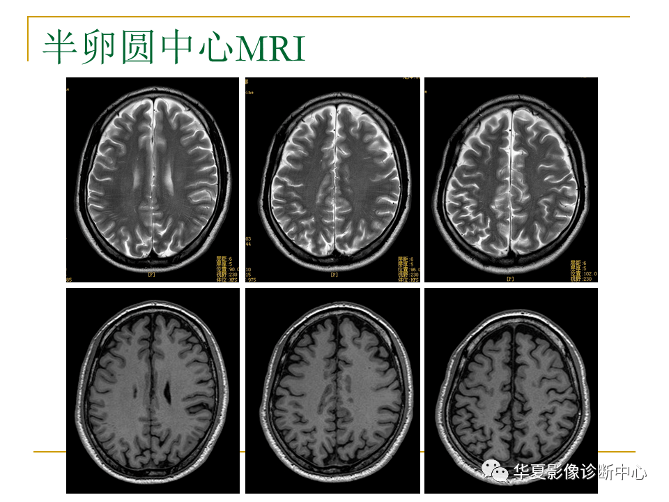 脑mri必备丨最详细的脑mri解剖