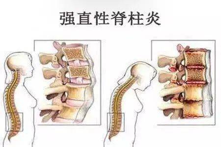 媒体报道小伙屁股疼了一年难入睡竟是遗传父亲强直性脊柱炎