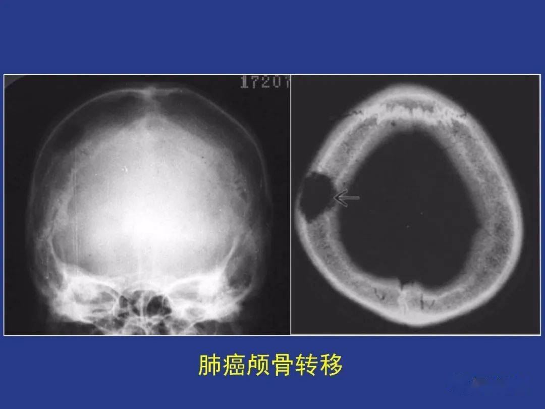 颅骨正常及常见变异的影像学表现