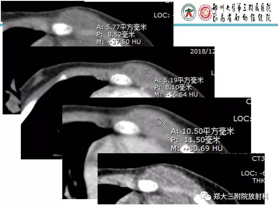 结节性筋膜炎影像表现