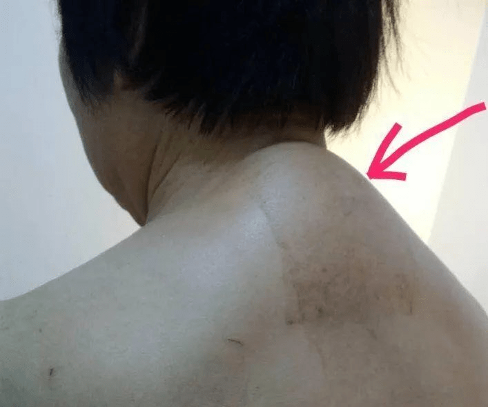 富贵包的影响因素确实比较多,比如不良姿势,骨质疏松,脂肪瘤等,有的