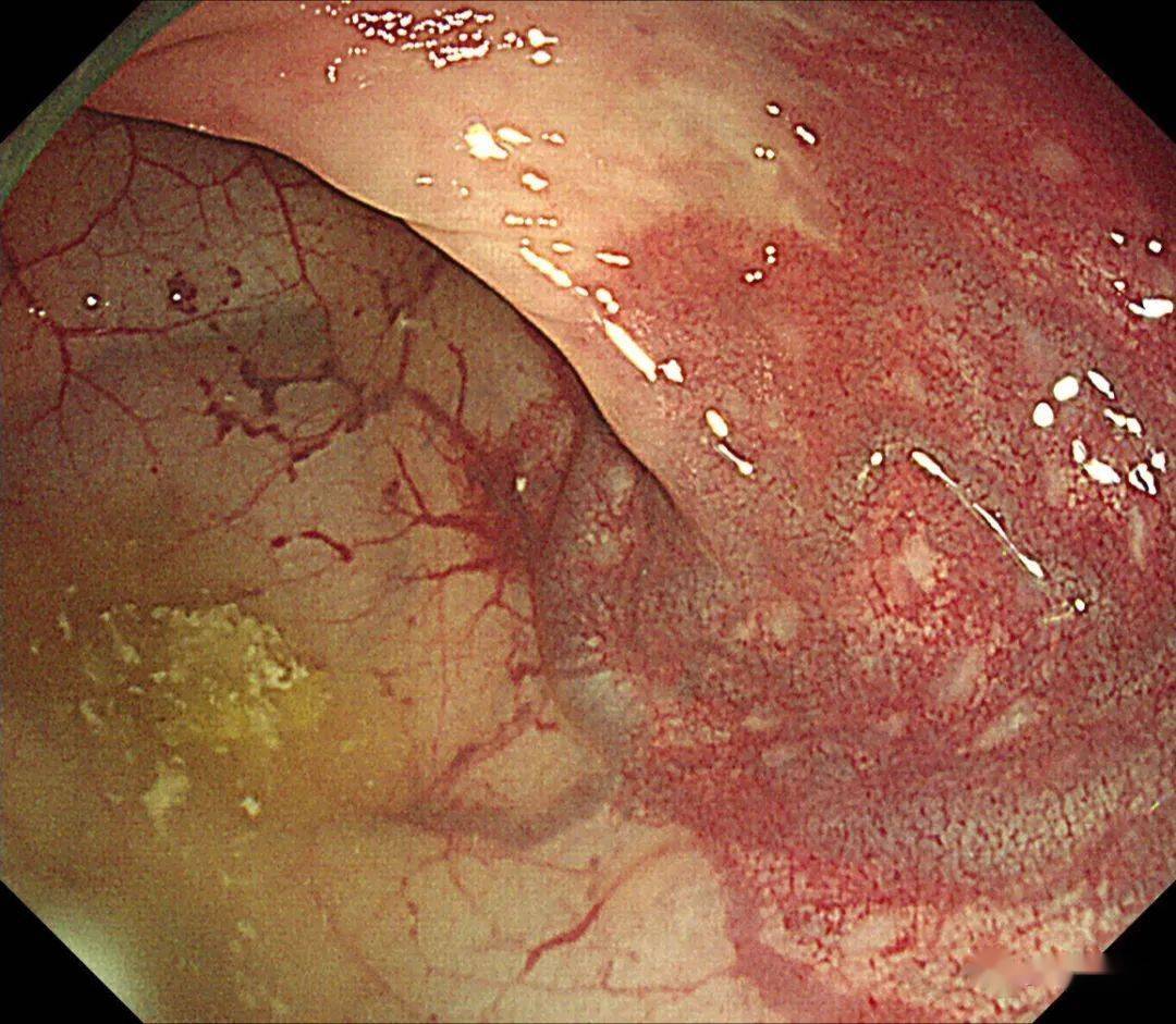 图(2):距肛门约18cm处(可见乙状结肠粘膜下异常扩张的血管,外观呈"