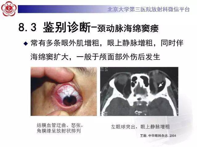 特发性眼眶炎性假瘤影像表现