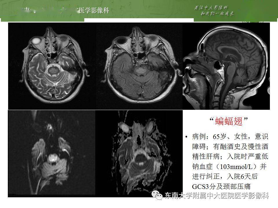 脑桥中央髓鞘溶解症影像表现