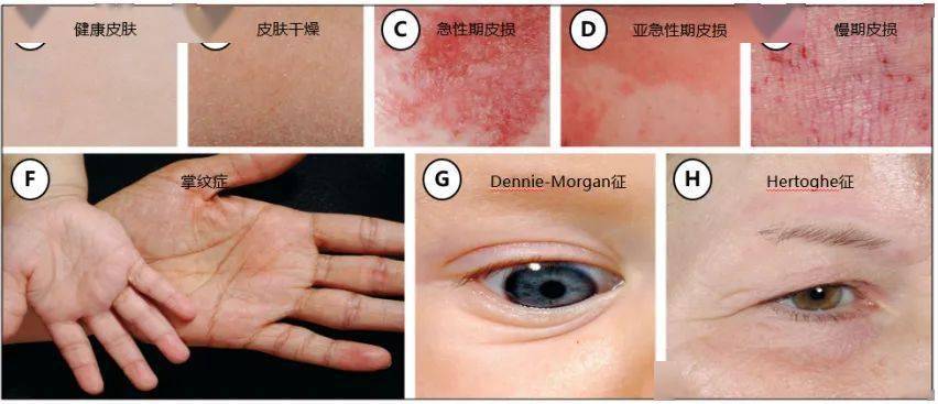 dermatitis ad)是一种慢性炎症性皮肤病