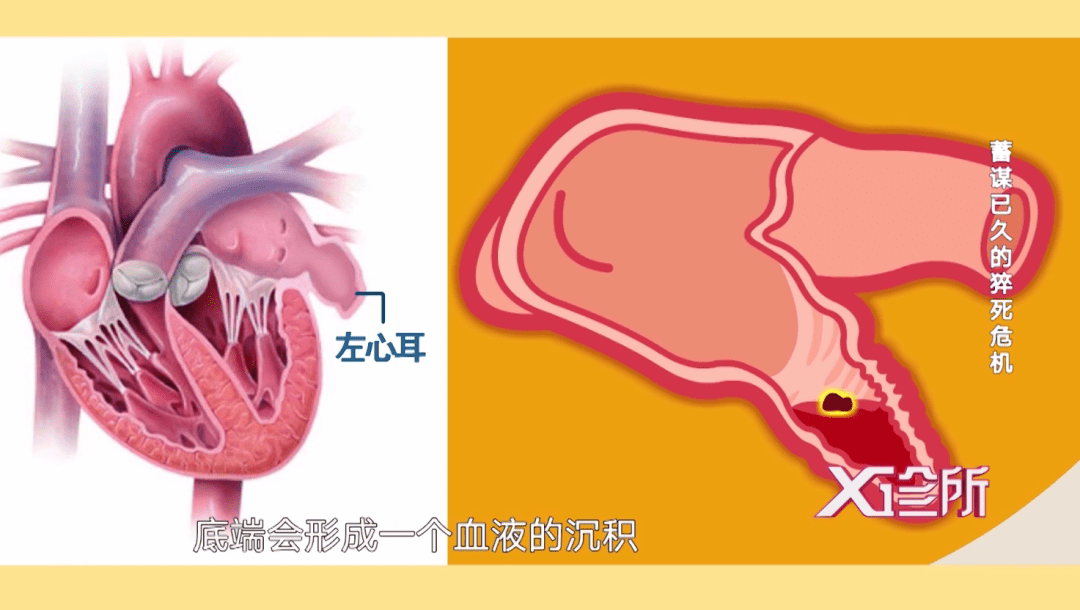 这是因为心脏有"两房两厅",左心房内有一个左心耳.