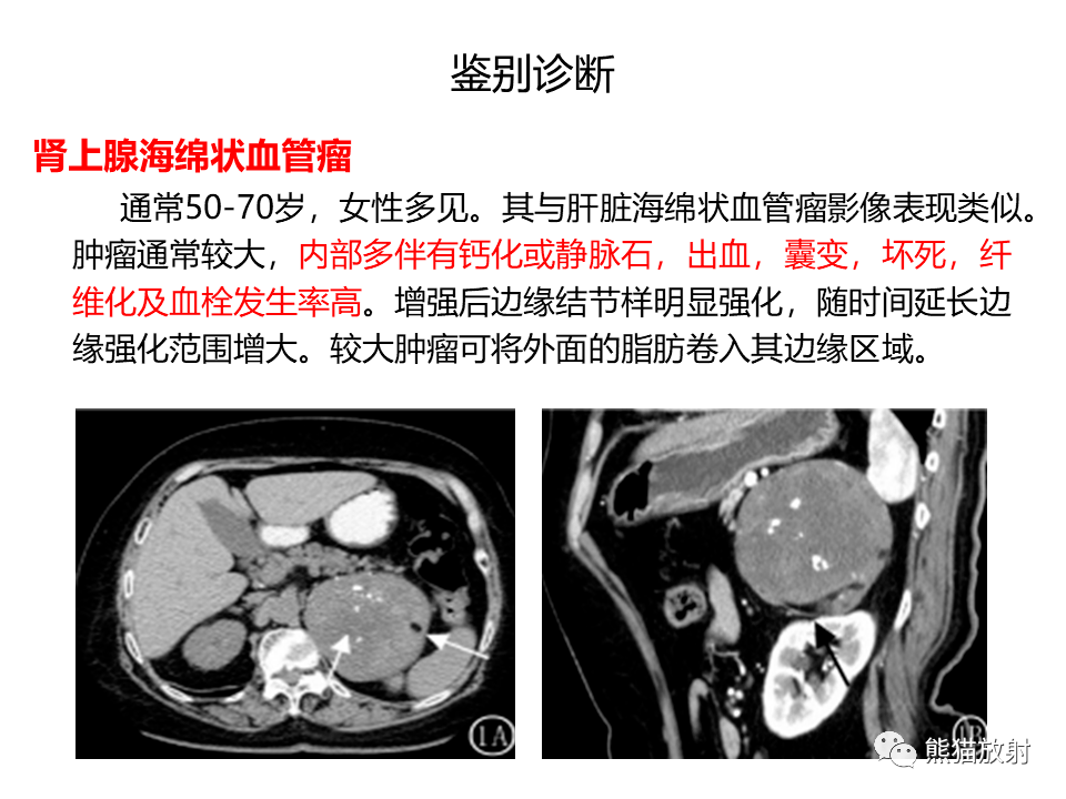 肾上腺皮质腺瘤