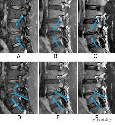 椎体和椎旁信号增高的非肿瘤性病变