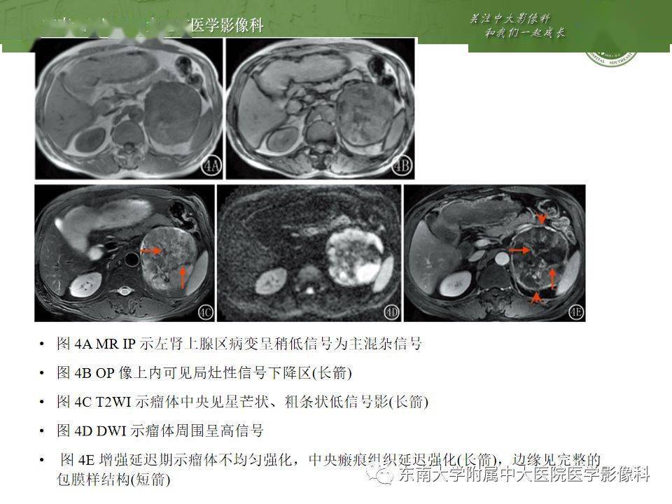 肾上腺嗜铬细胞瘤ct诊断与鉴别诊断