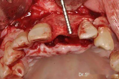 切牙孔多生牙拔除水平骨增量