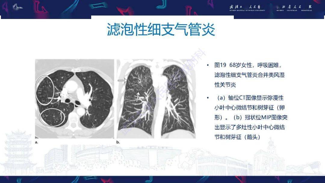 精彩推荐 细支气管炎影像诊断