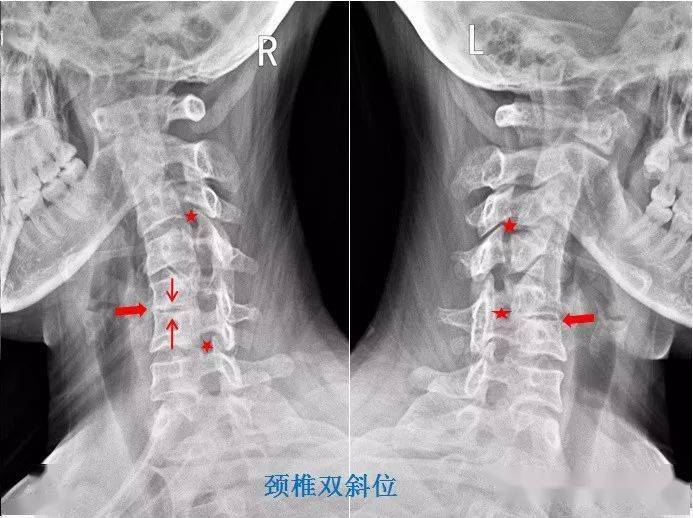 影像科医生告诉你宅家疯狂玩手机你的颈椎可能会这样