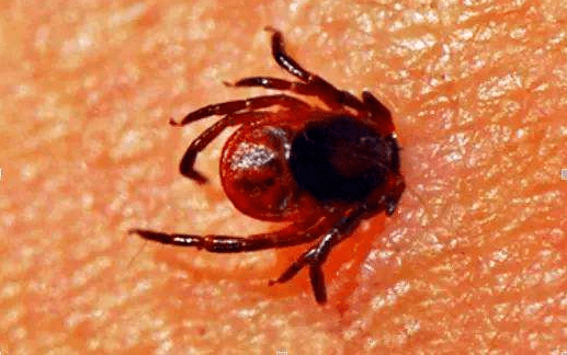 恙虫病,又名丛林斑疹伤寒,是由恙虫病立克次体引起的急性传染病,是一