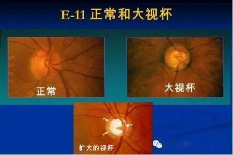 眼底视神经和上面的例子很相似,杯盘比是指视盘(视乳头)视杯的垂直径