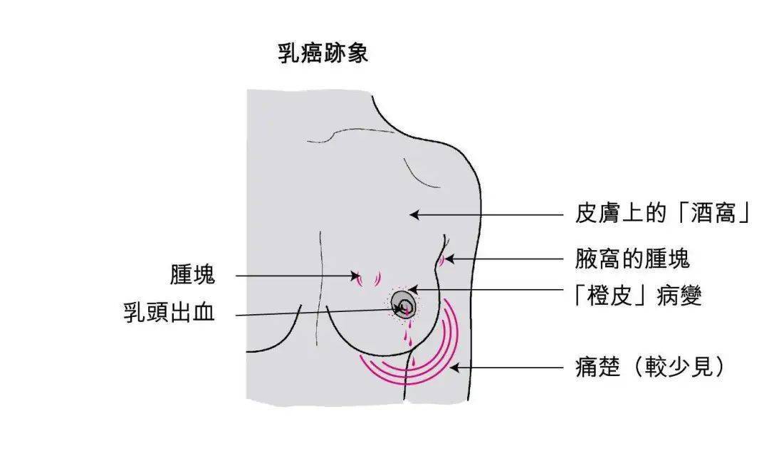 乳腺癌是中国女性发病率最高的癌症类型,其发病率呈逐年递增趋势,且