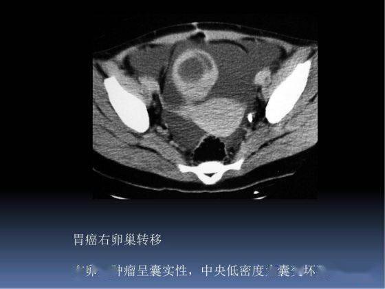 5大卵巢恶性肿瘤如何在ct上寻找蛛丝马迹医学影像经典ppt