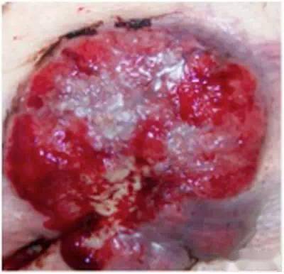 图4: 过度增生的肉芽组织高于伤口周围皮肤平面,质地柔软,没有正常