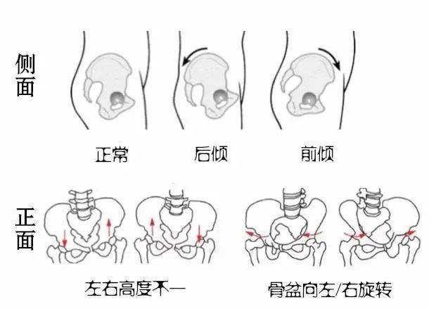 健康生活有些腰疼可能是骨盆歪了